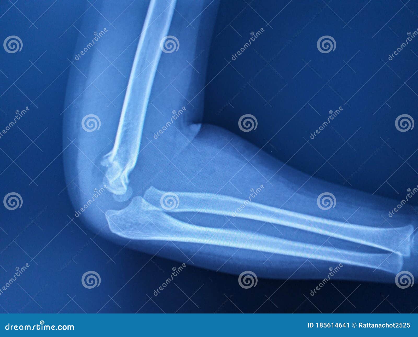 x-ray elbow joint lateral view a female 3 year old finding supracondylar fracture distal humerus with joint effusion.no dislocatio
