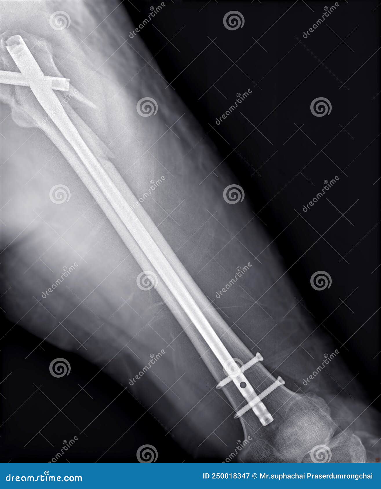 X Ray Femur Bone With Total Hip And Femur Replacement Stock Image