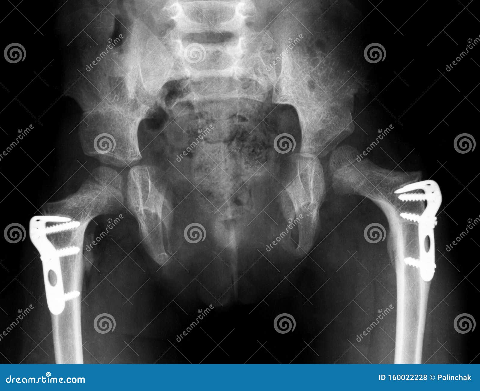 X Ray Film Broken Bone Stock Photo Image Of Broken X Ray Film Broken Bone Stock Photo Image Of Broken