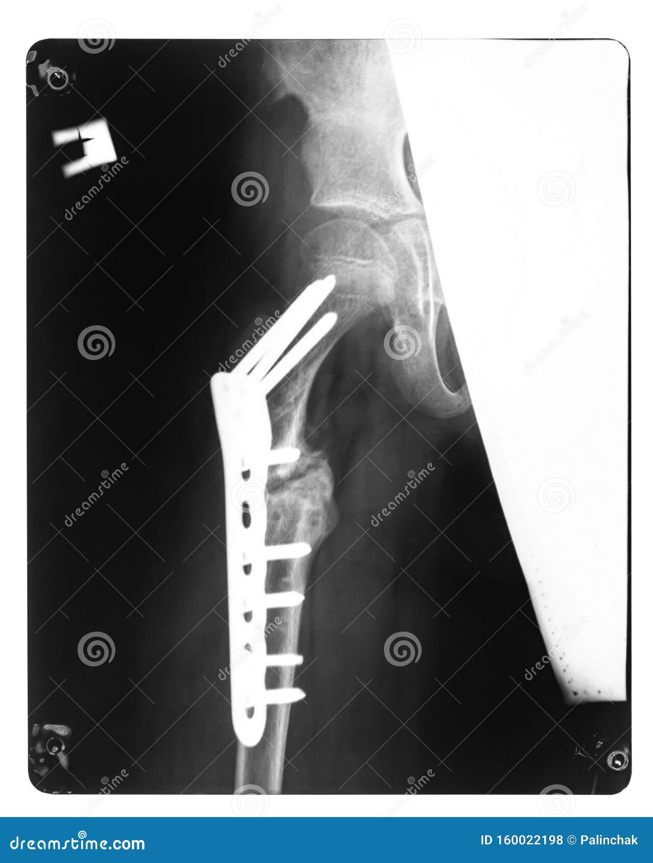 X Ray Film Broken Bone Stock Photo Image Of Doctor X Ray Film Broken Bone Stock Photo Image Of Doctor