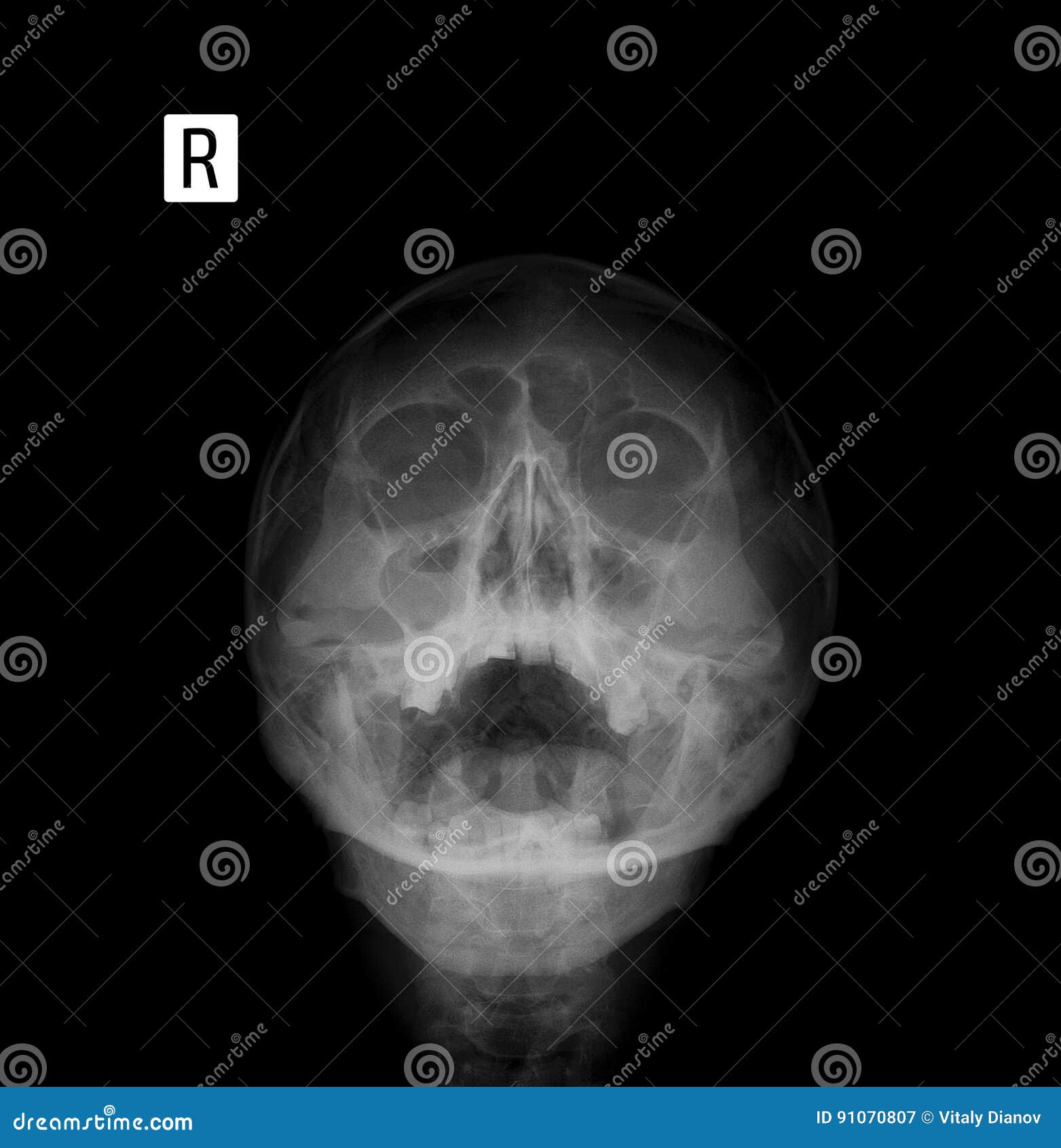 Sinusitis Film X Ray Of Human Skull With Inflamed At Sinus Stock Photography Cartoondealer