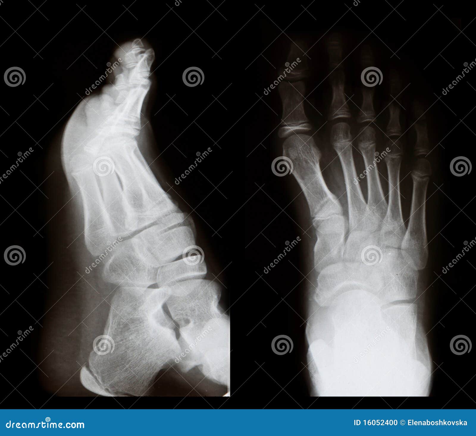 Xray of a foot stock photo. Image of orthopedic, patient 16052400
