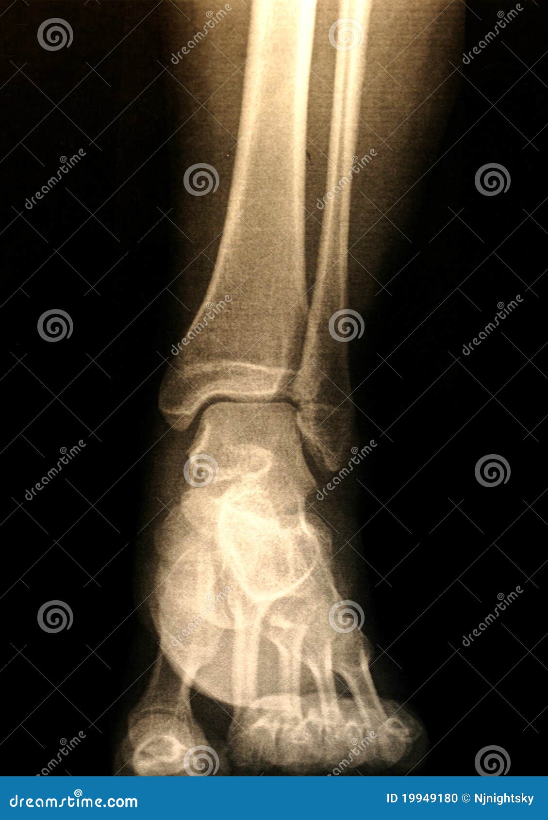 Xray of a foot stock photo. Image of joint, body, radiology 19949180