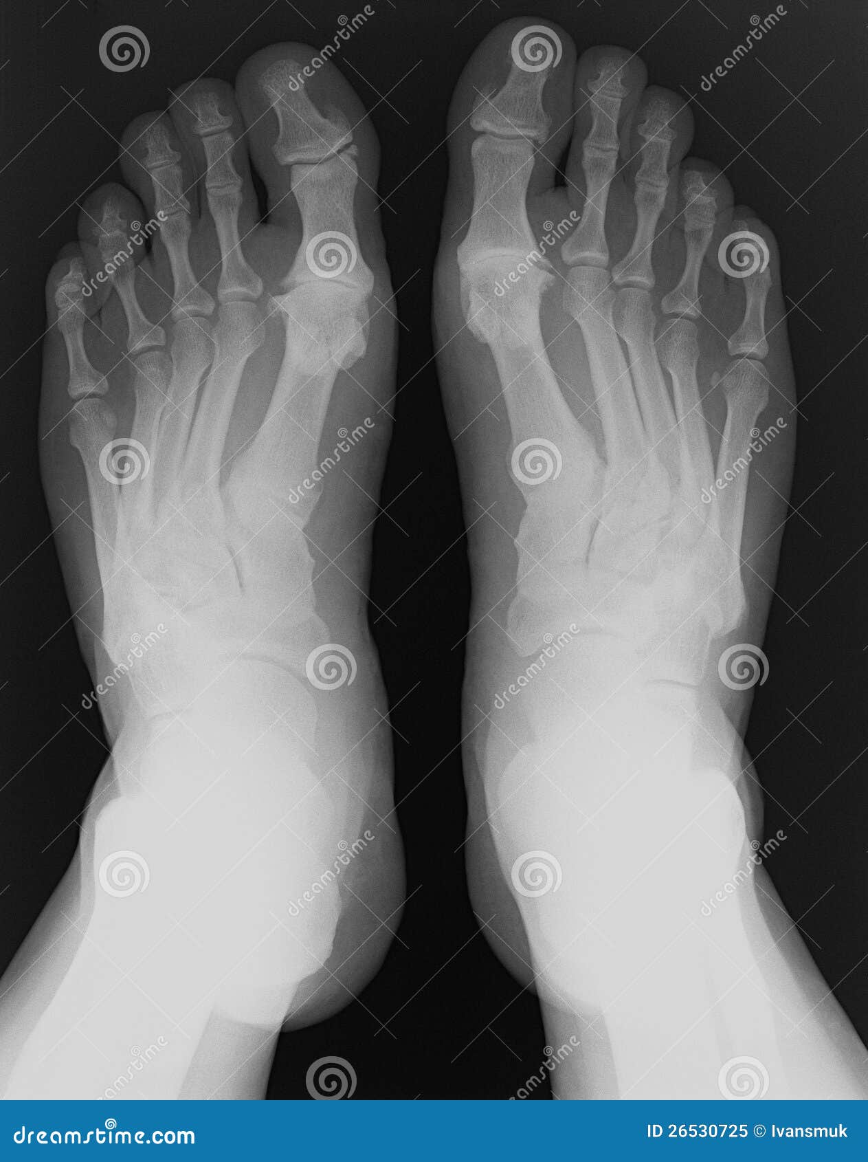 Xray foot stock image. Image of diagnostic, arthritis 26530725