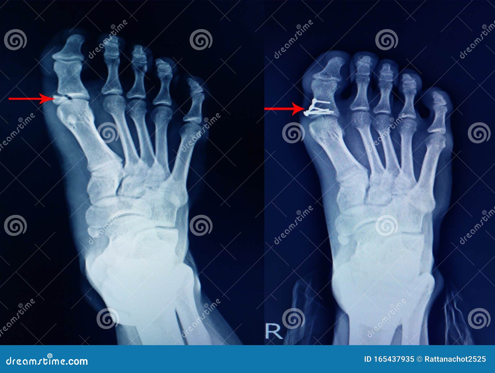 x-ray foot fracture proximal phalang and surgery fix mini plate and screws