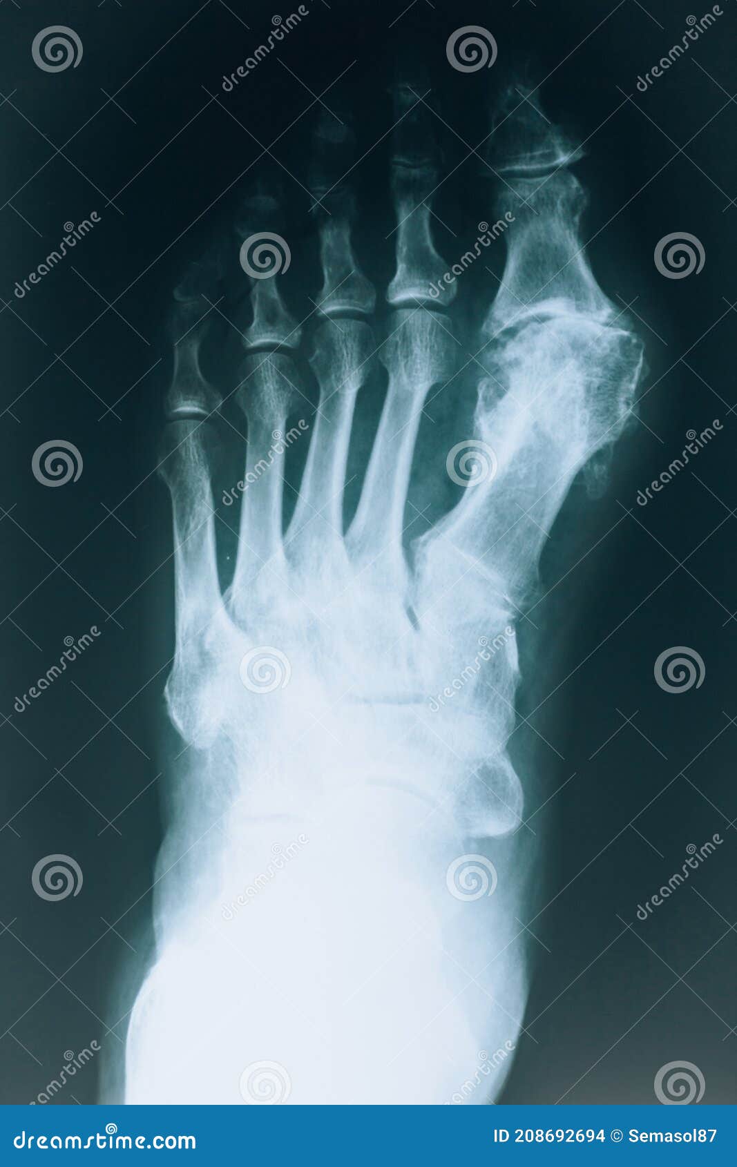 Xray Of The Foot. Human Bones. Real Xray Leg, Side View. RoyaltyFree