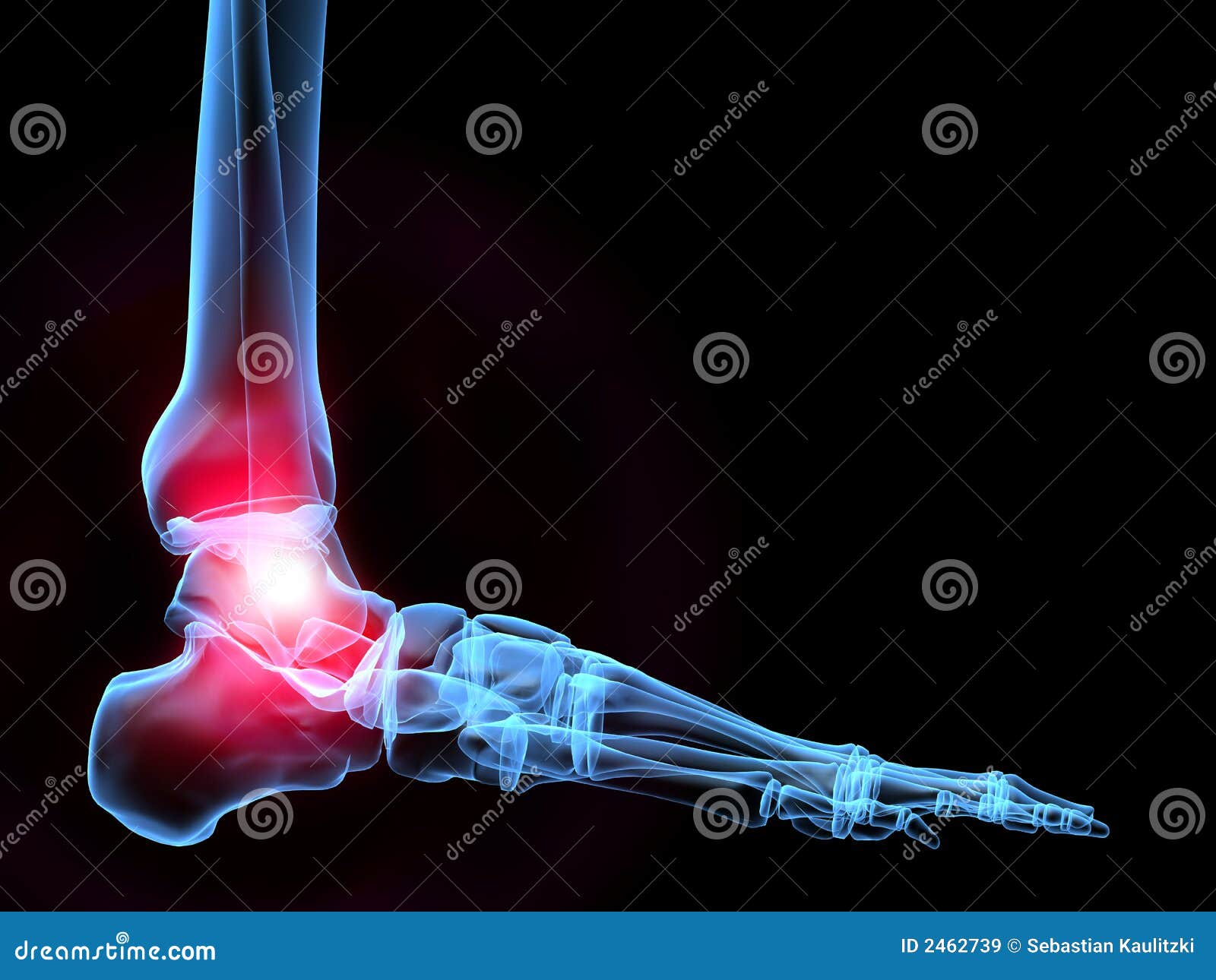 Xray foot with pain stock illustration. Illustration of science 2462739