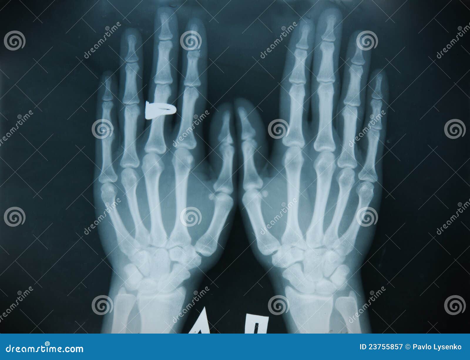 Xray hand (finger) stock image. Image of scan, medicine 23755857