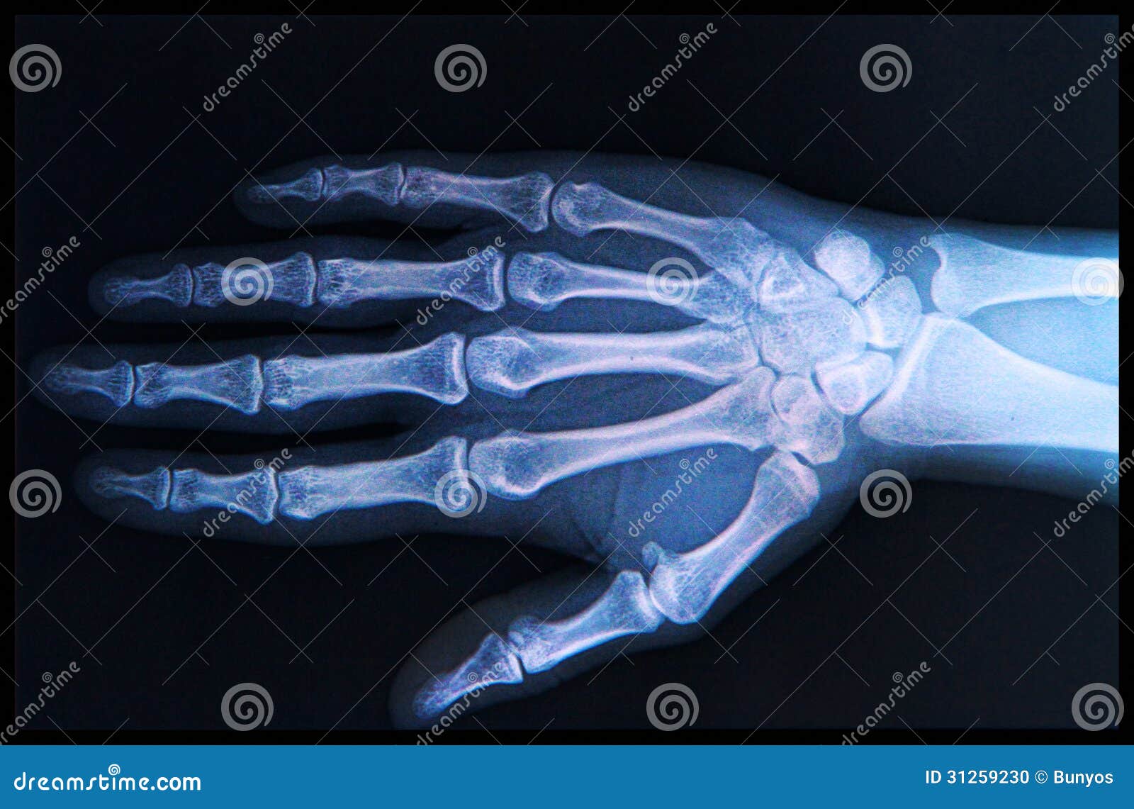 x-ray of hand and fingers