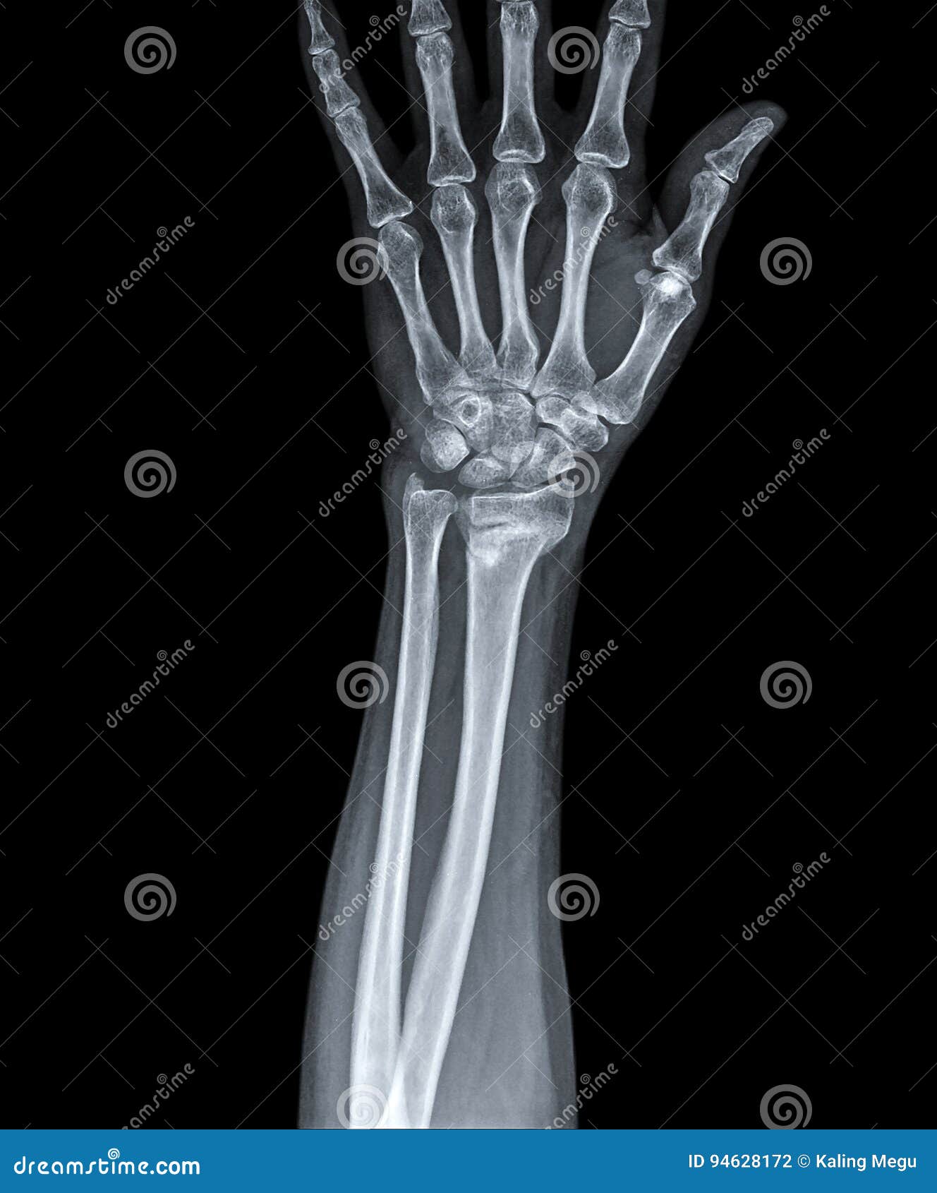 X Ray of Hand with Fracture Radius Stock Photo - Image of care, pelvic:  94628172