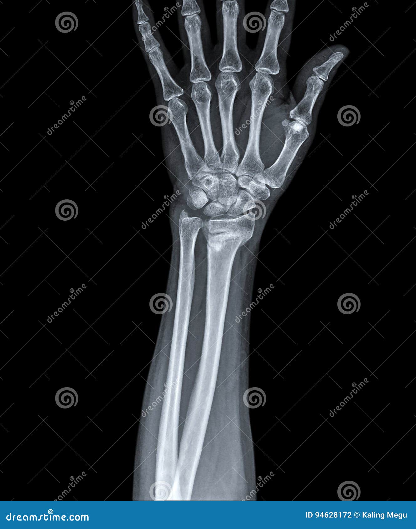X Ray of Hand with Fracture Radius Stock Photo Image of care, pelvic
