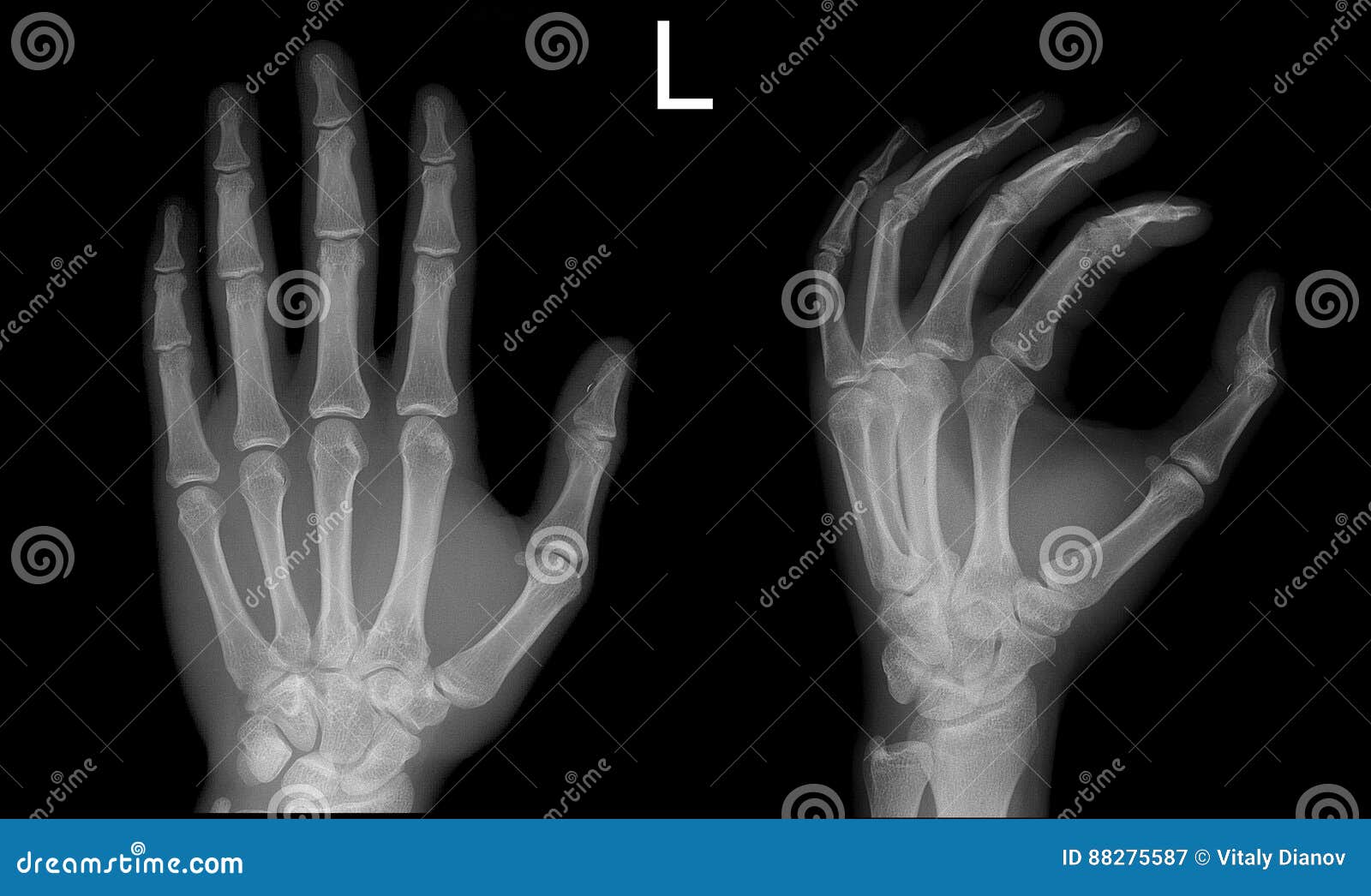 X-ray Hand Frontal Oblique View Normal Stock Image - Image of middle, lifestyle: 88275587