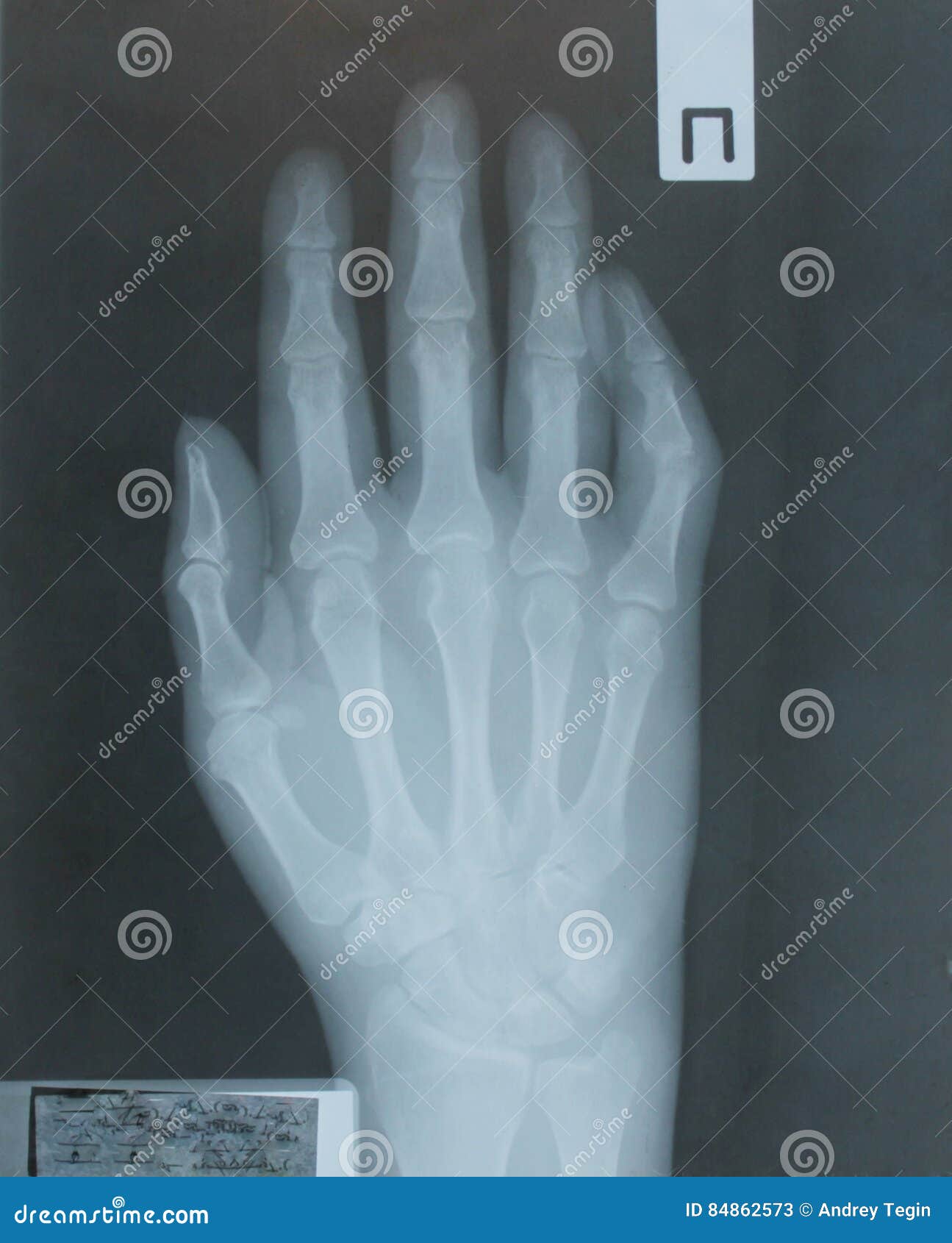 X-ray of hand of patient with osteoarthritis