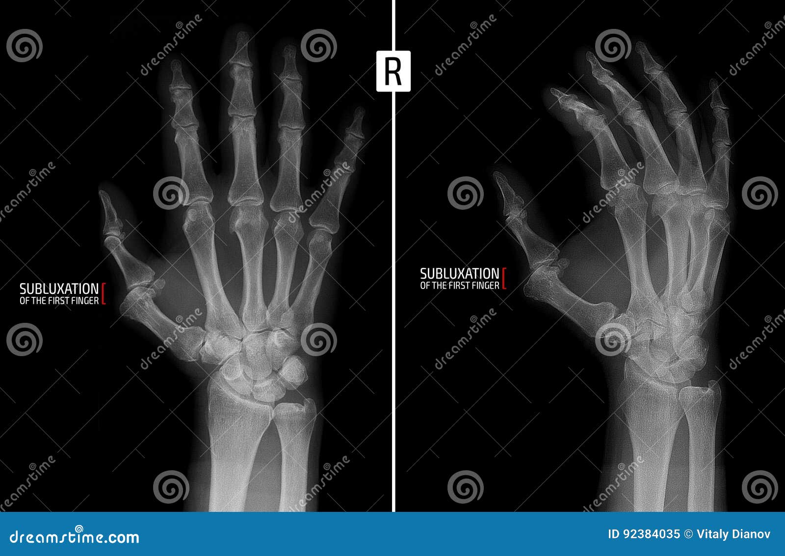 x-ray of the hand. shows the subluxation of the proximal phalanx of the first finger of the right hand. marker.