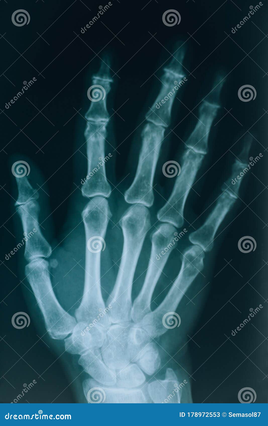 x-ray of the hands. real x-ray picture of a hand with fingers. at the doctorÃ¢â¬â¢s appointment, hospital.