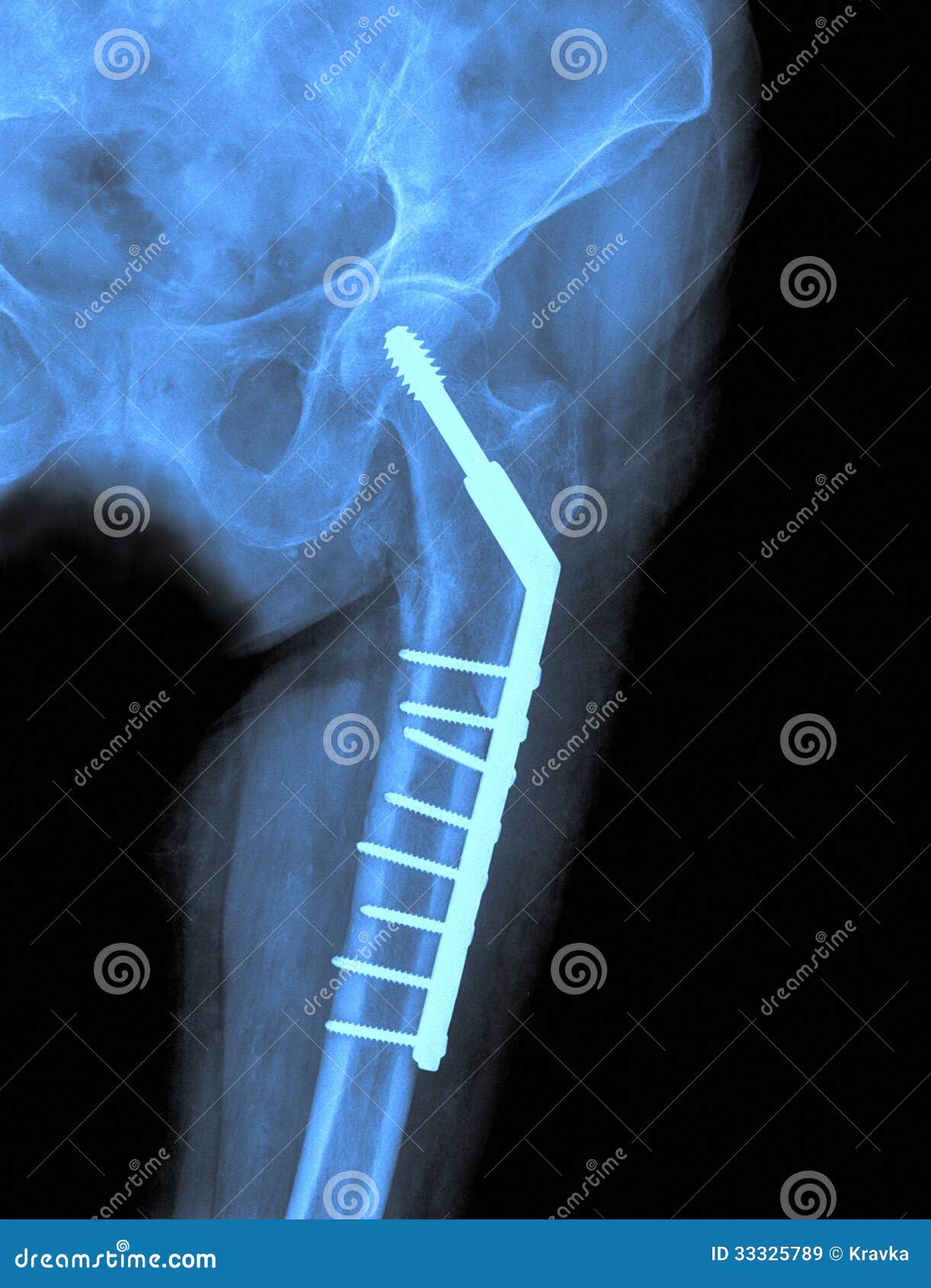 Xray of the Hip Prosthesis Stock Image Image of therapy, rays 33325789