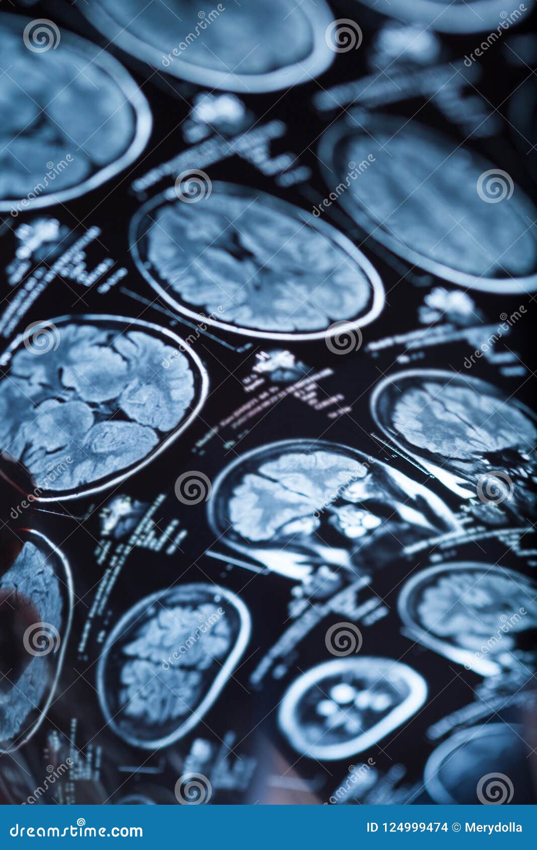 The Xray of the Human Brain Stock Photo Image of disease, neurology