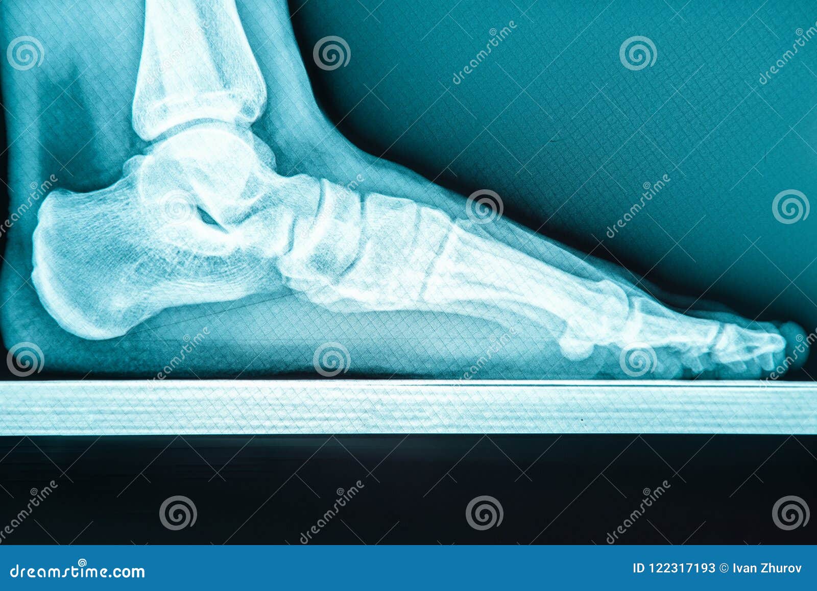 Xray Human Foot with Flatfoot Stock Image Image of lateral, patient