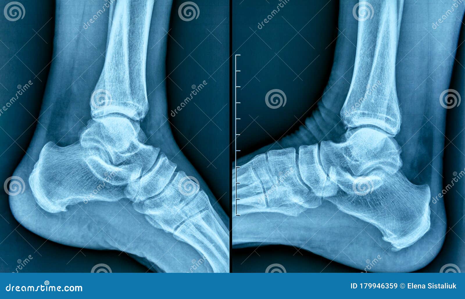 calcaneal spur xray