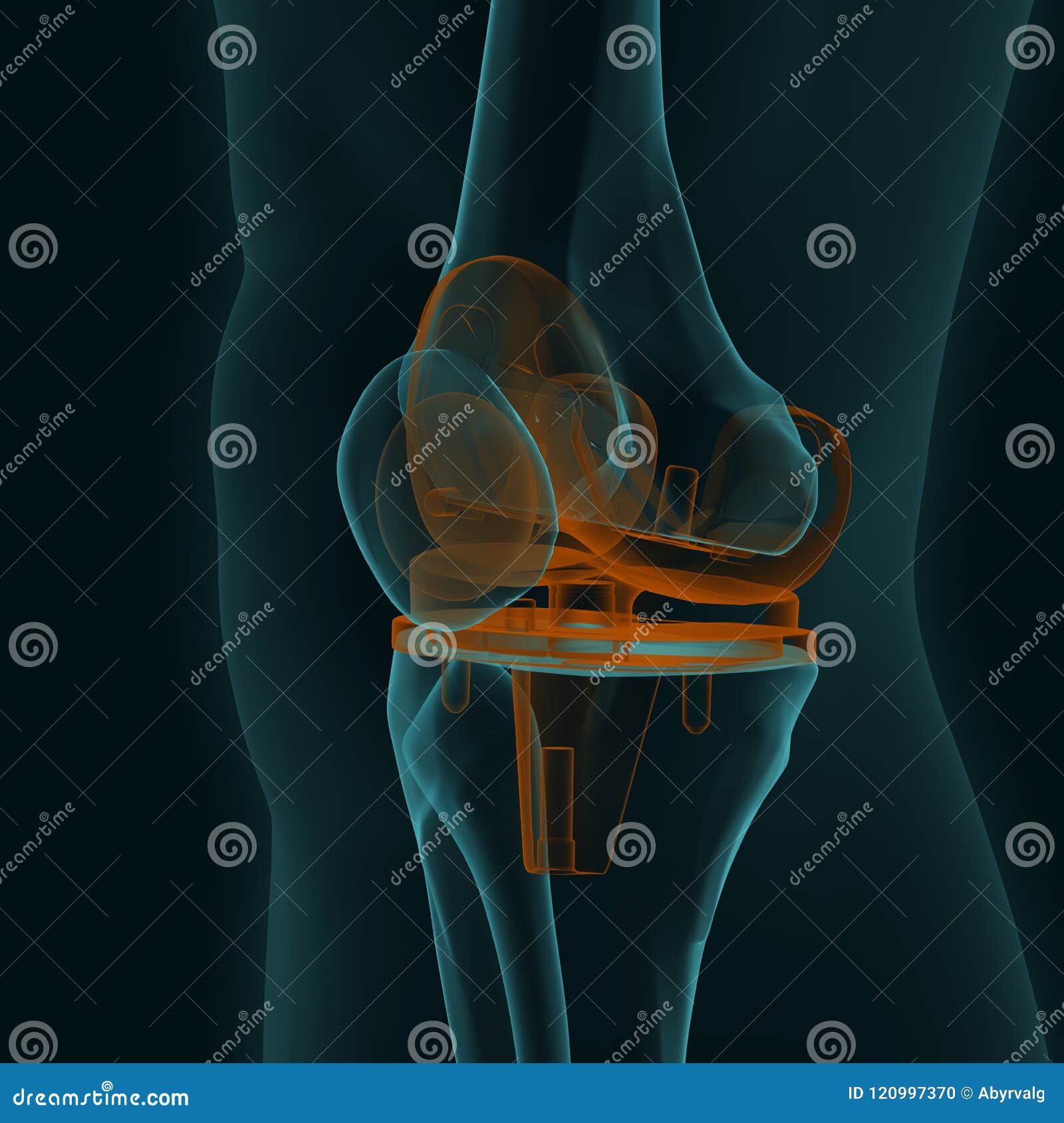 Xray of a Human Knee with Knee Replacement Stock Illustration
