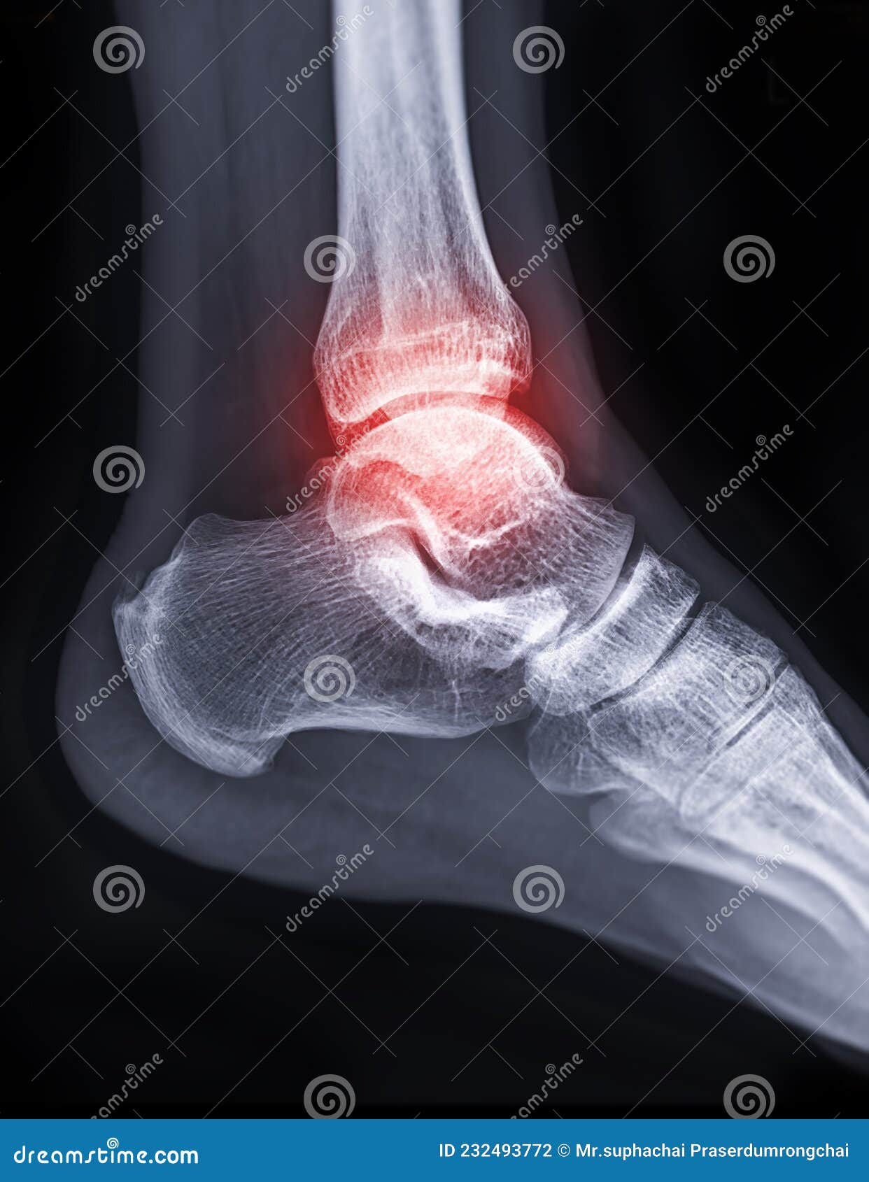 Xray Image of Ankle Joint Showing Fracture of Ankle Joint Stock Photo