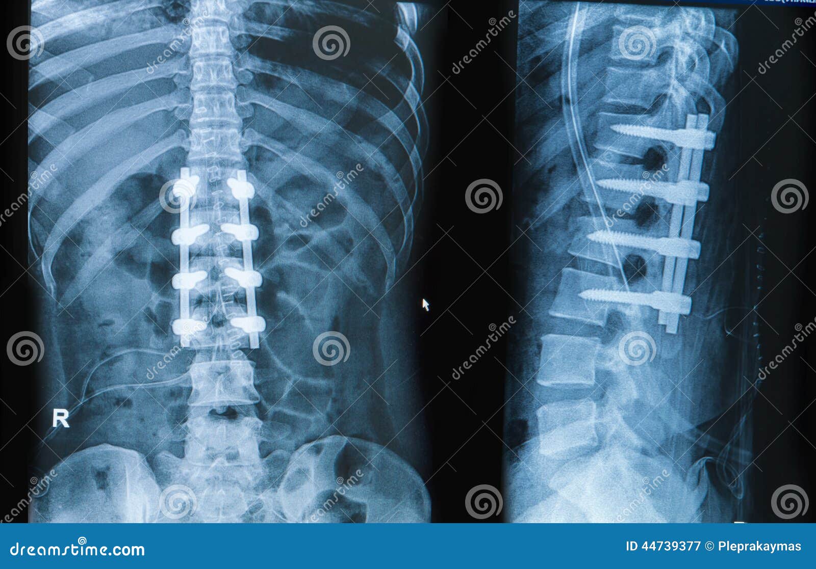 x-ray image of back pain show spinal column with implant fusion