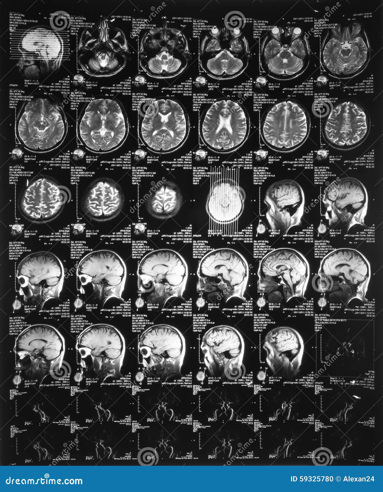 x-ray image of the brain computed tomography