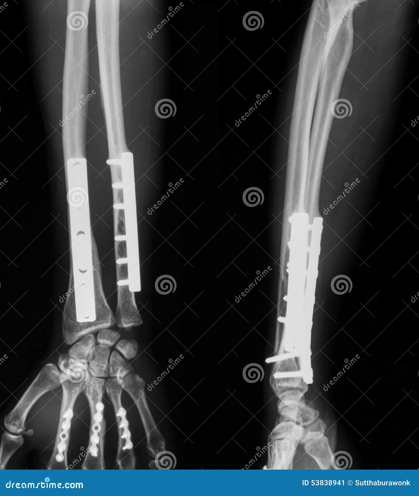 Xray Image Of Broken Forearm. Stock Image Image 53838941