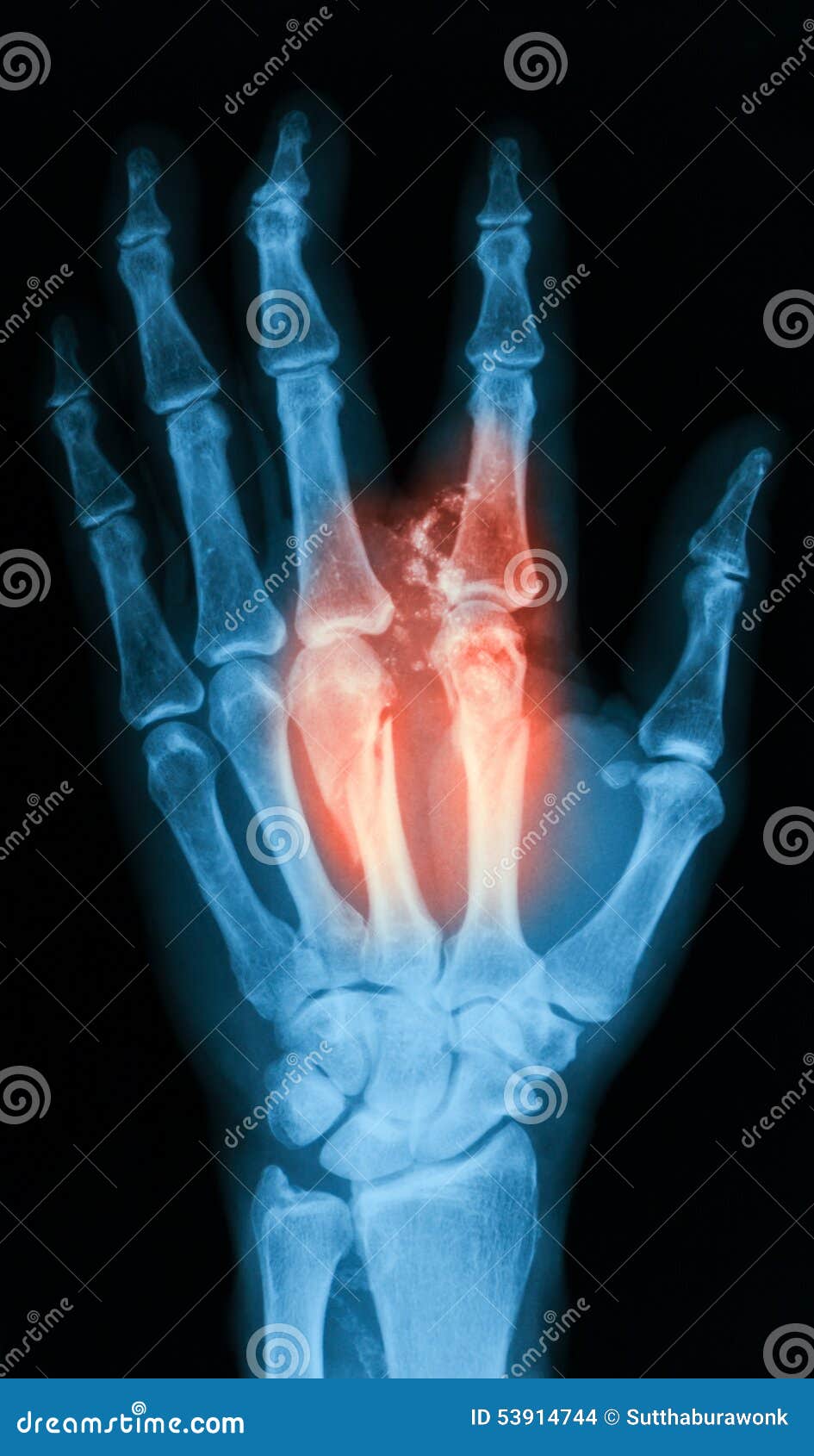 Xray Image of Broken Hand, AP View. Stock Photo Image of medical