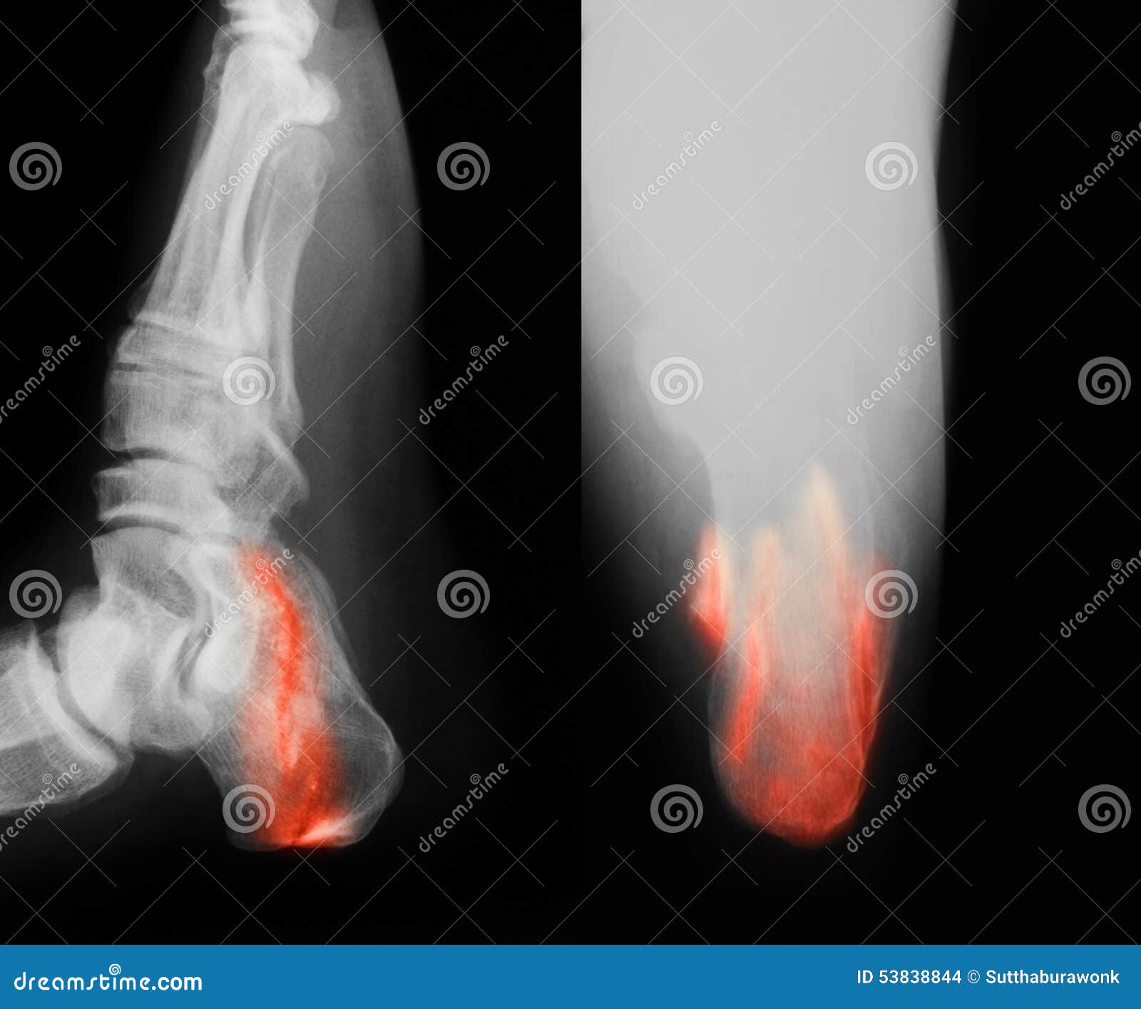 X-ray Left Calcaneum AP Axial | Test Price in Delhi | Ganesh Diagnostic