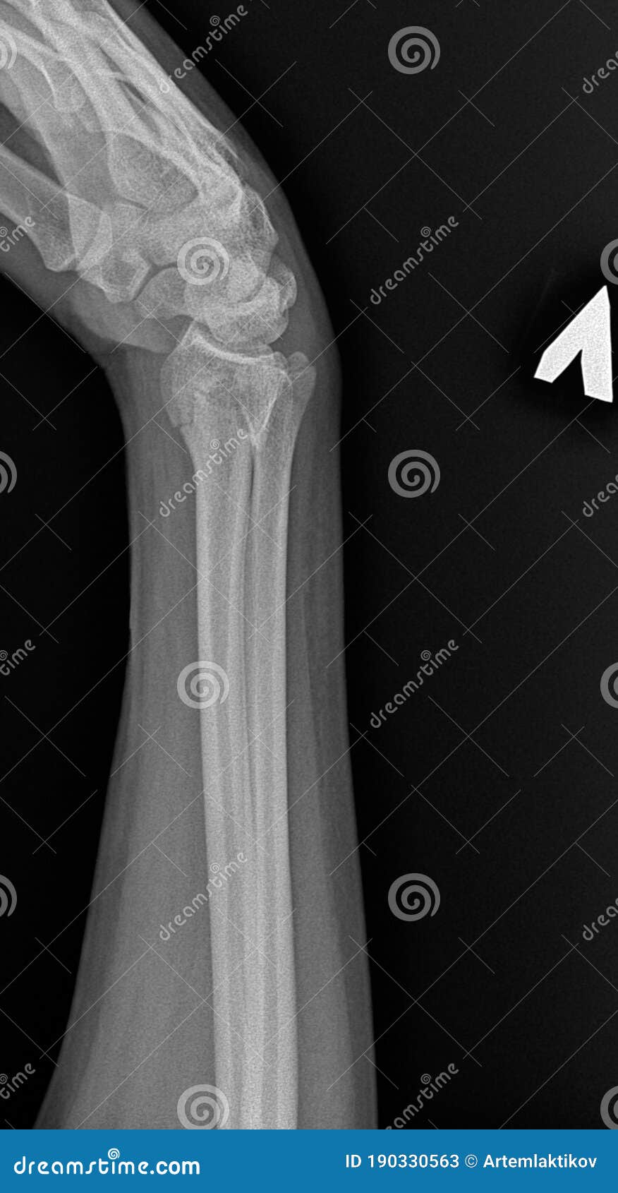 Xray Image of Cracked Human Bone. Wrist Fracture Stock Image Image