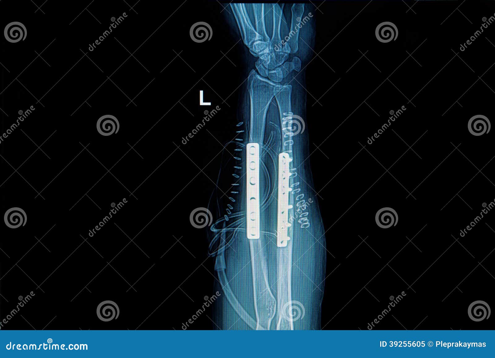 X Ray Image Of Forearm With Implant Stock Image Image Of Plate Xray