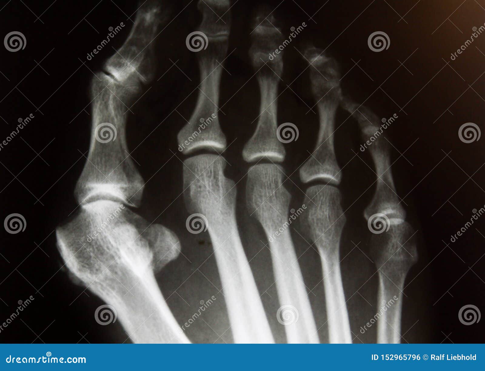 x-ray image of forefoot with hallux valgus deformity