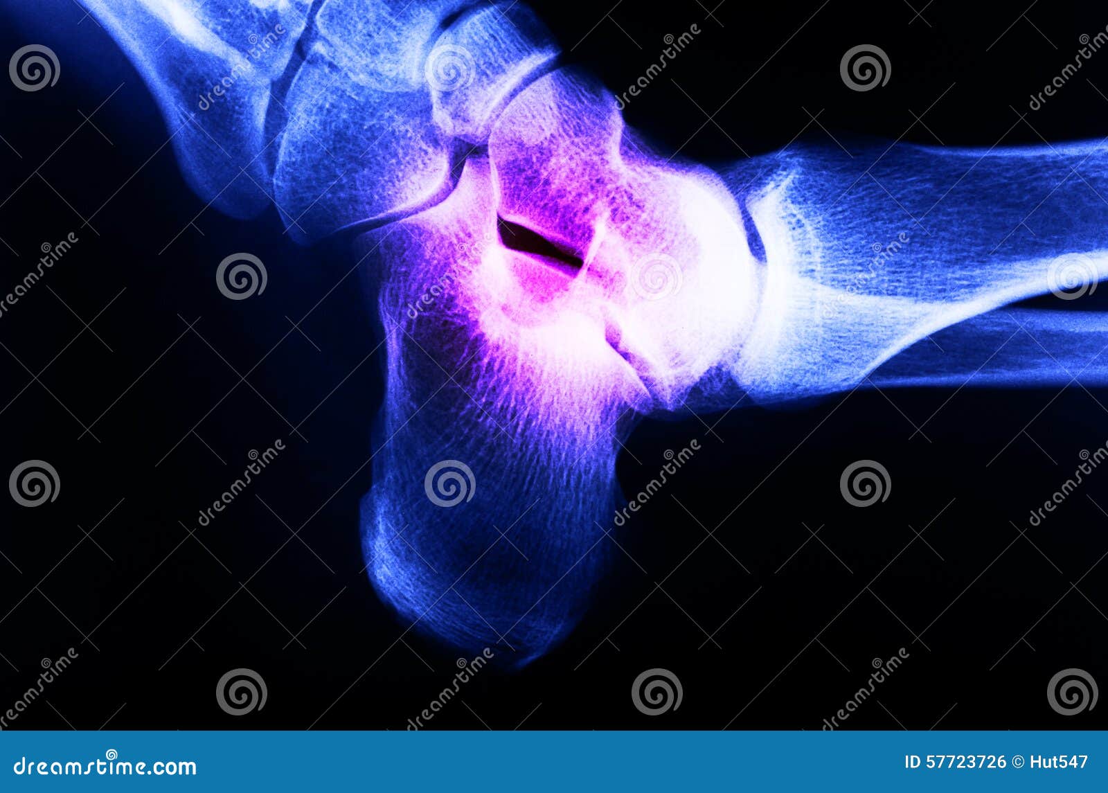 Xray Image of Human Foot Joint Stock Photo Image of human, diagnostic 57723726
