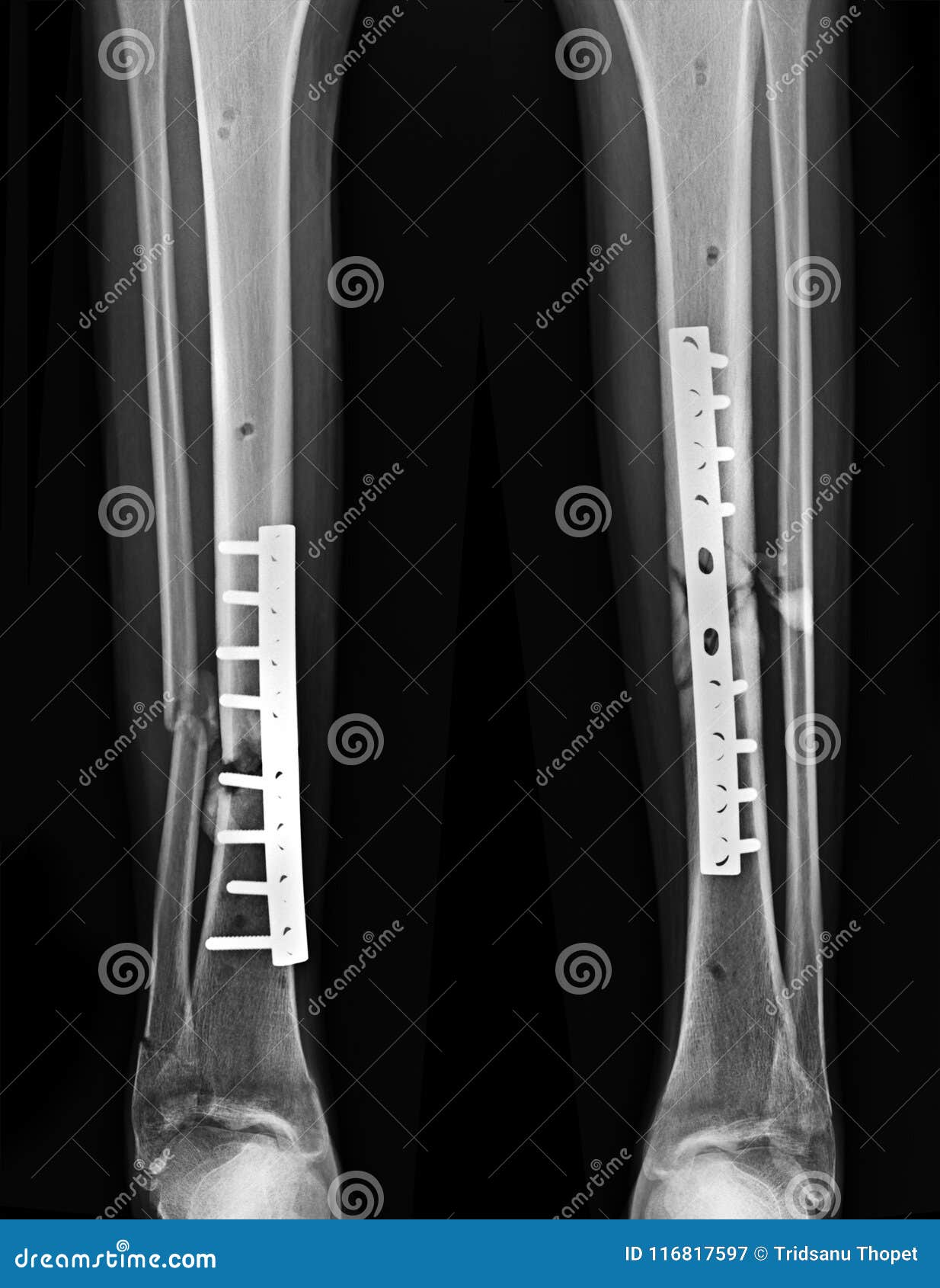 Leg fracture xray image stock image. Image of background 116817597