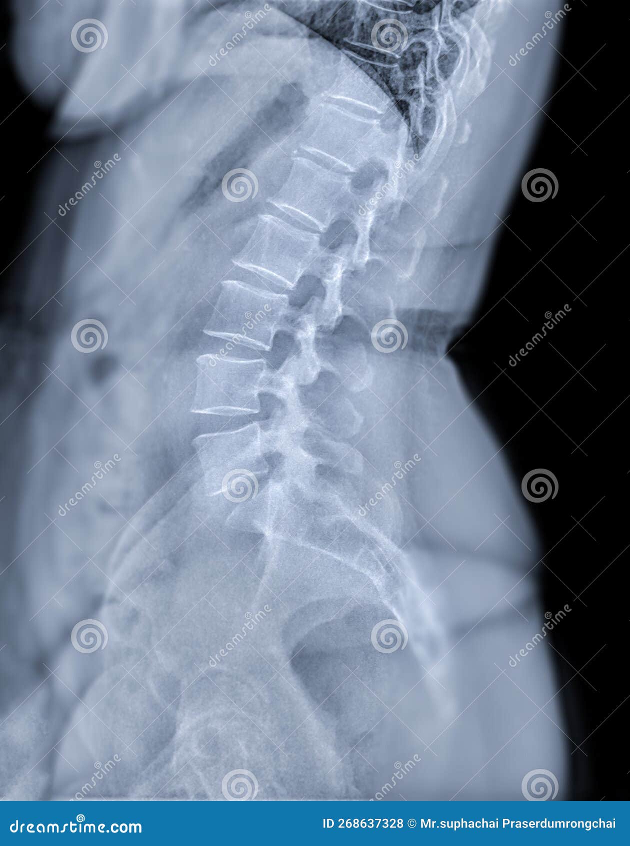 X-ray Image of Lumbar Spine or L-s Spine Lateral View for