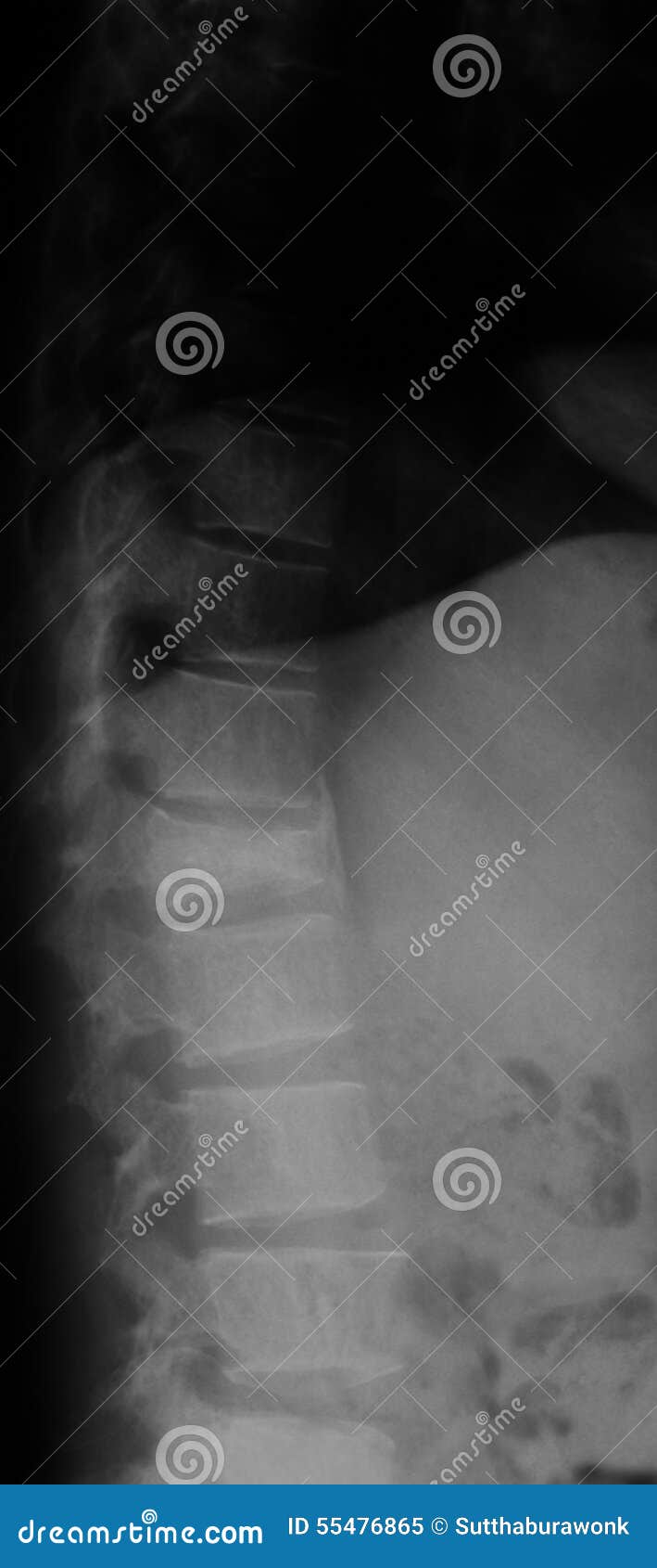 Lumbar Fracture X Ray