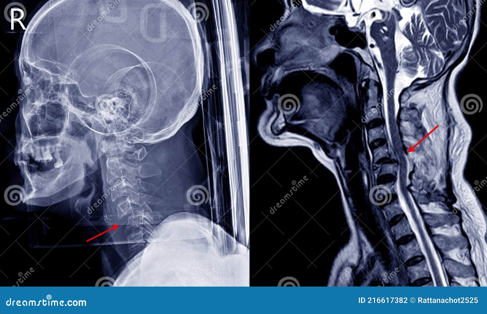 Cervical Spine Dislocation