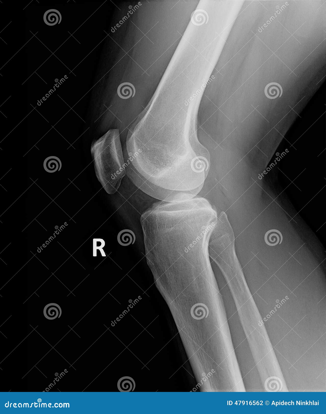 XRay Image of Perfect Knee and Leg Stock Photo Image of emit, light
