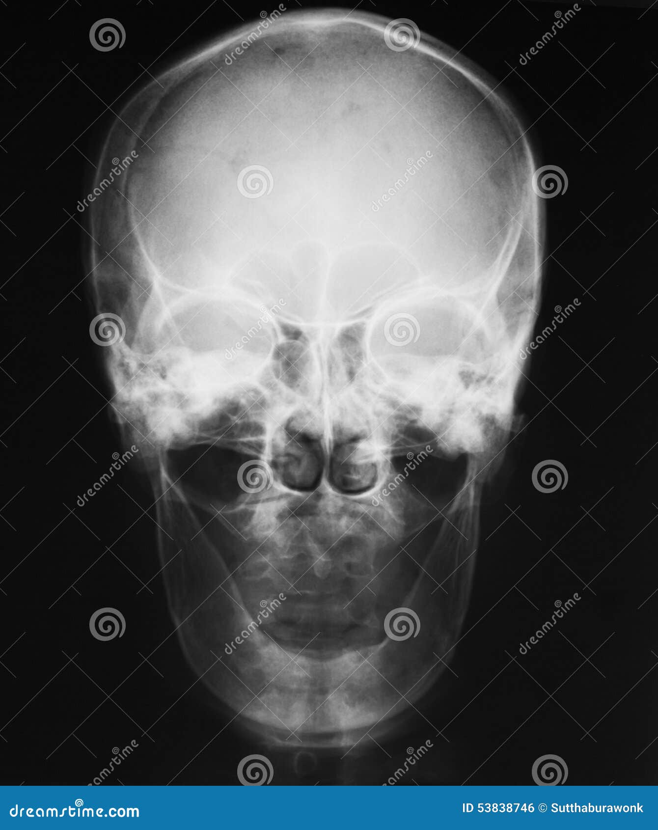 Xray Image Of Mandible, Lateral View. RoyaltyFree Stock Photography