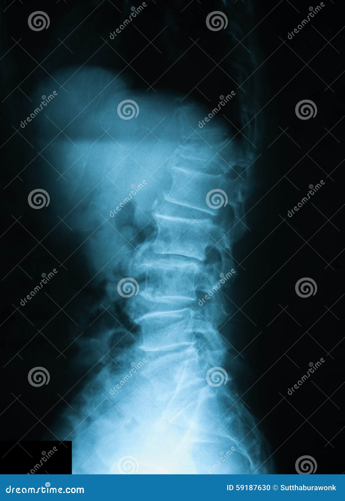 t12 compression fracture