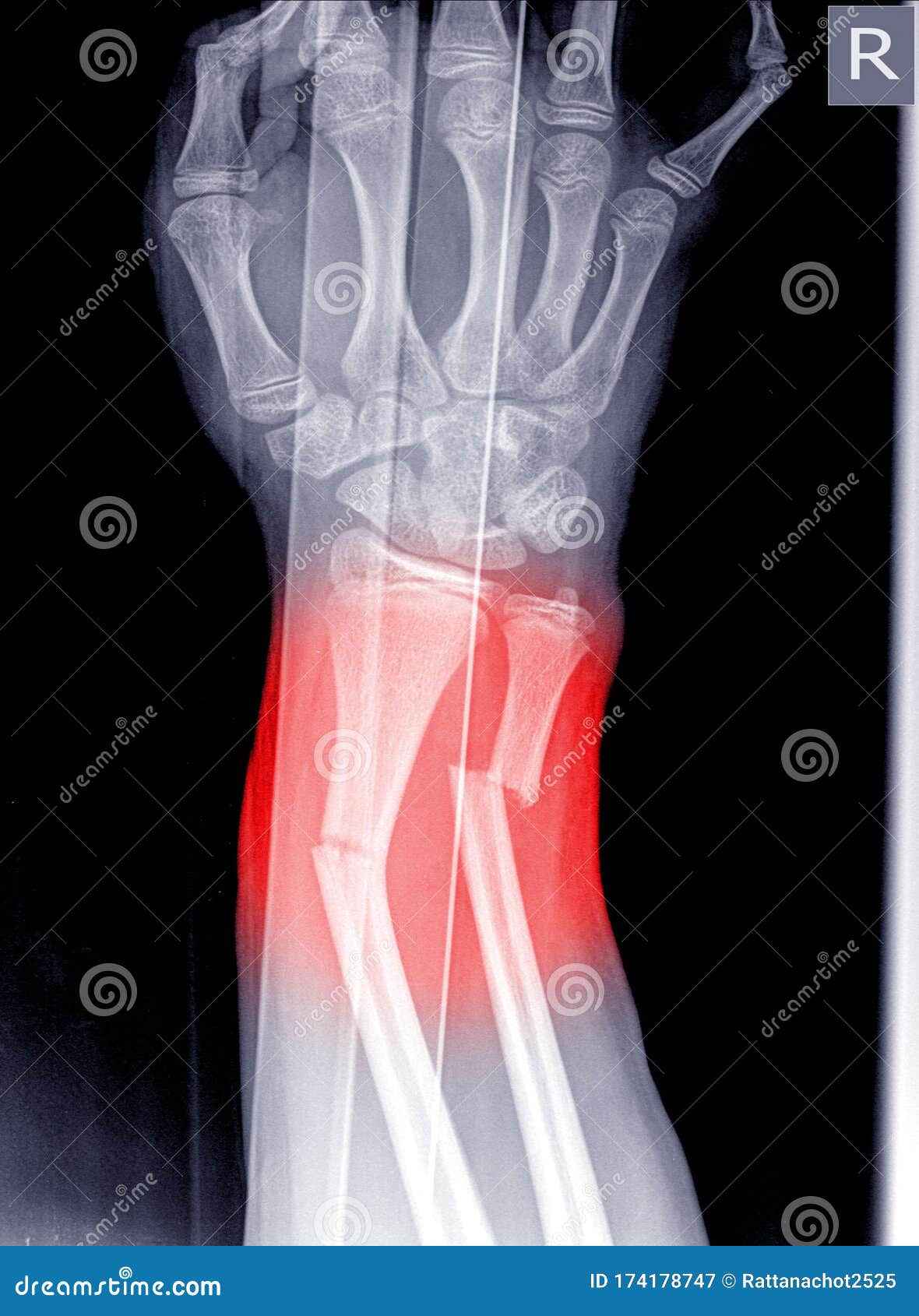 x-ray image of wrist joint, shows fracture of the distal radius and ulna on color mark
