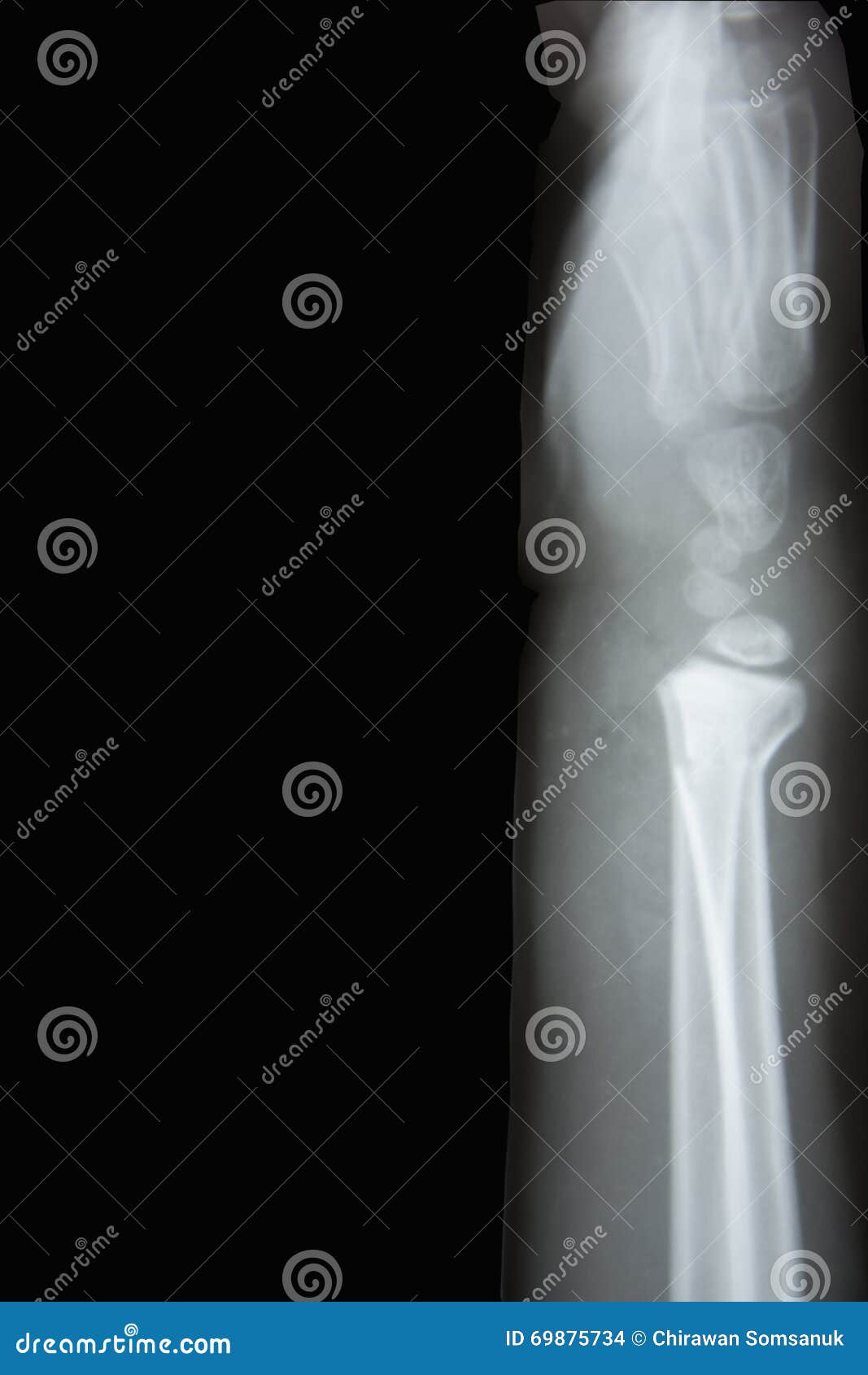 Xray joint stock photo. Image of hospital, osteoarthritis 69875734