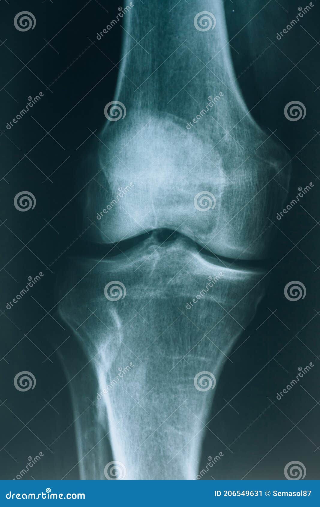 Xray of the Knee Joint. Knee Bone Injury Stock Image Image of knee