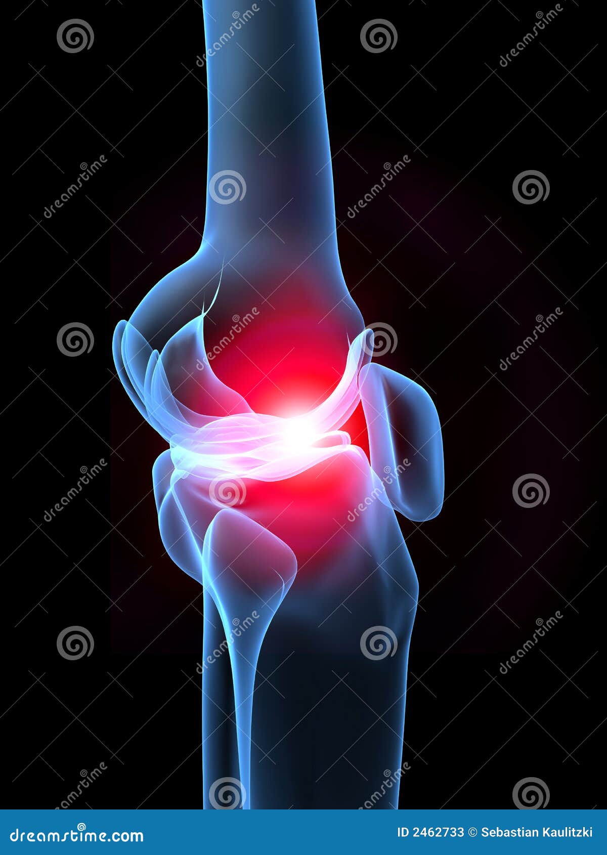 Xray knee with pain stock illustration. Illustration of human 2462733