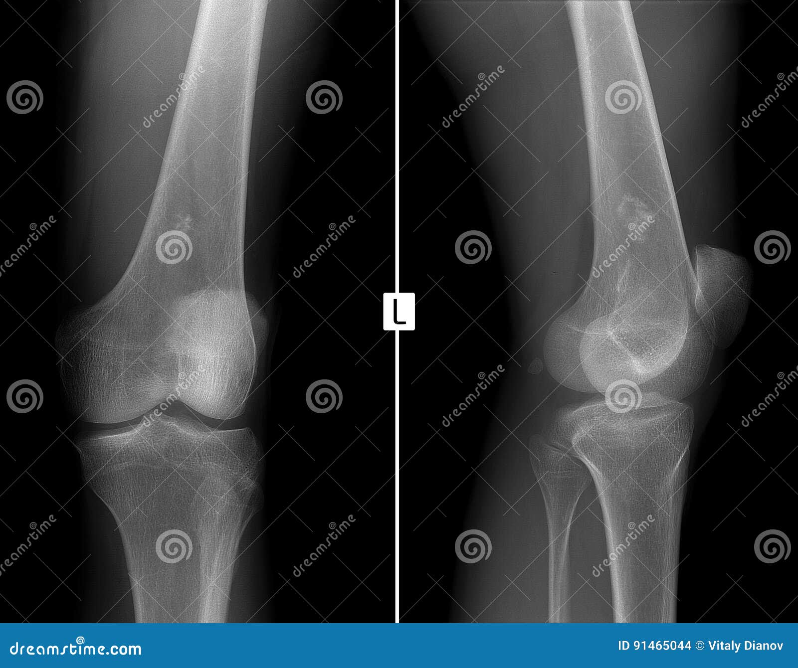 x-ray of the left knee joint. ewing sarcoma, lymphoma, myeloma thigh bone.