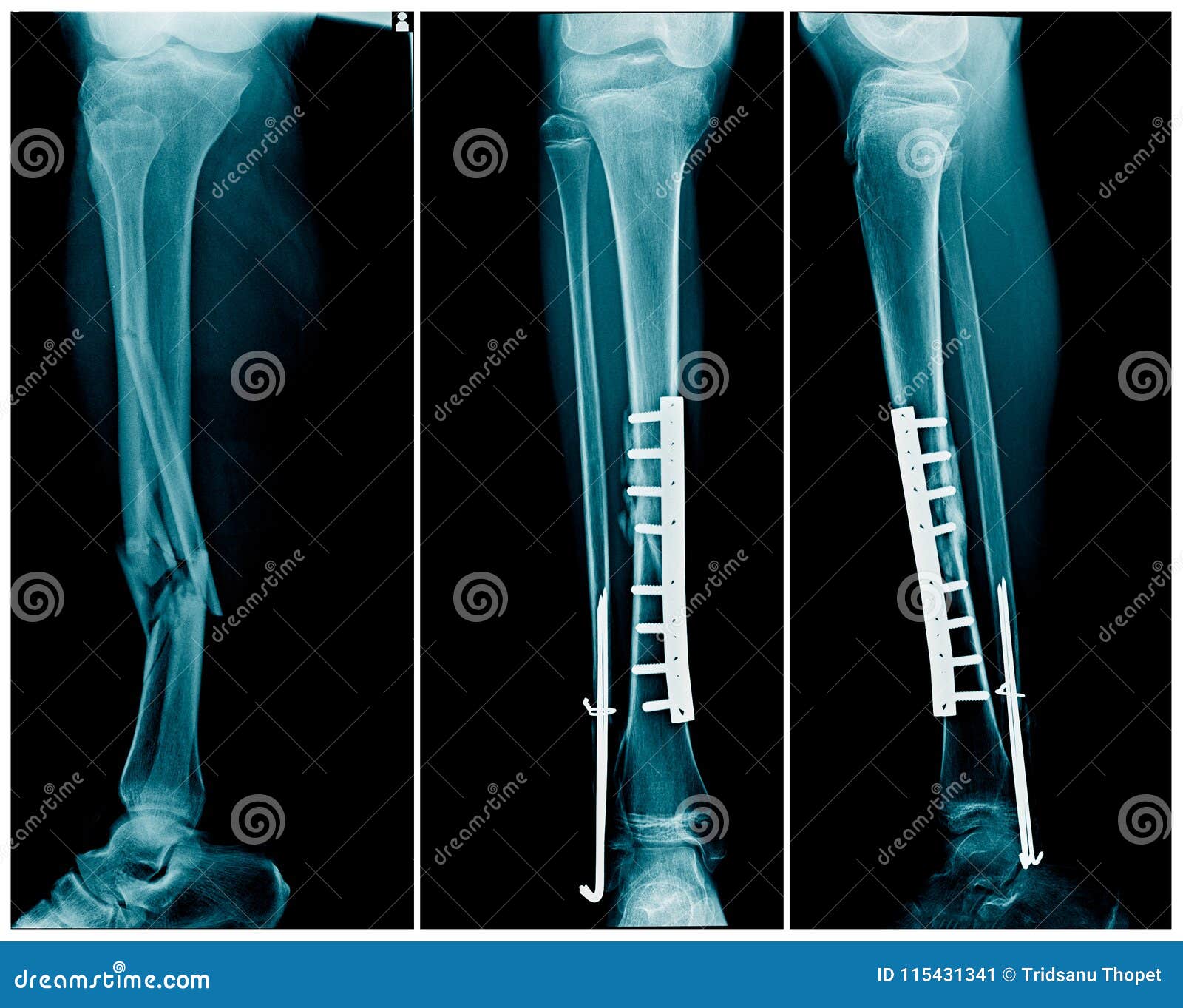 Fracture Of Leg With Post Op Fixation Royalty Free Stock Photography