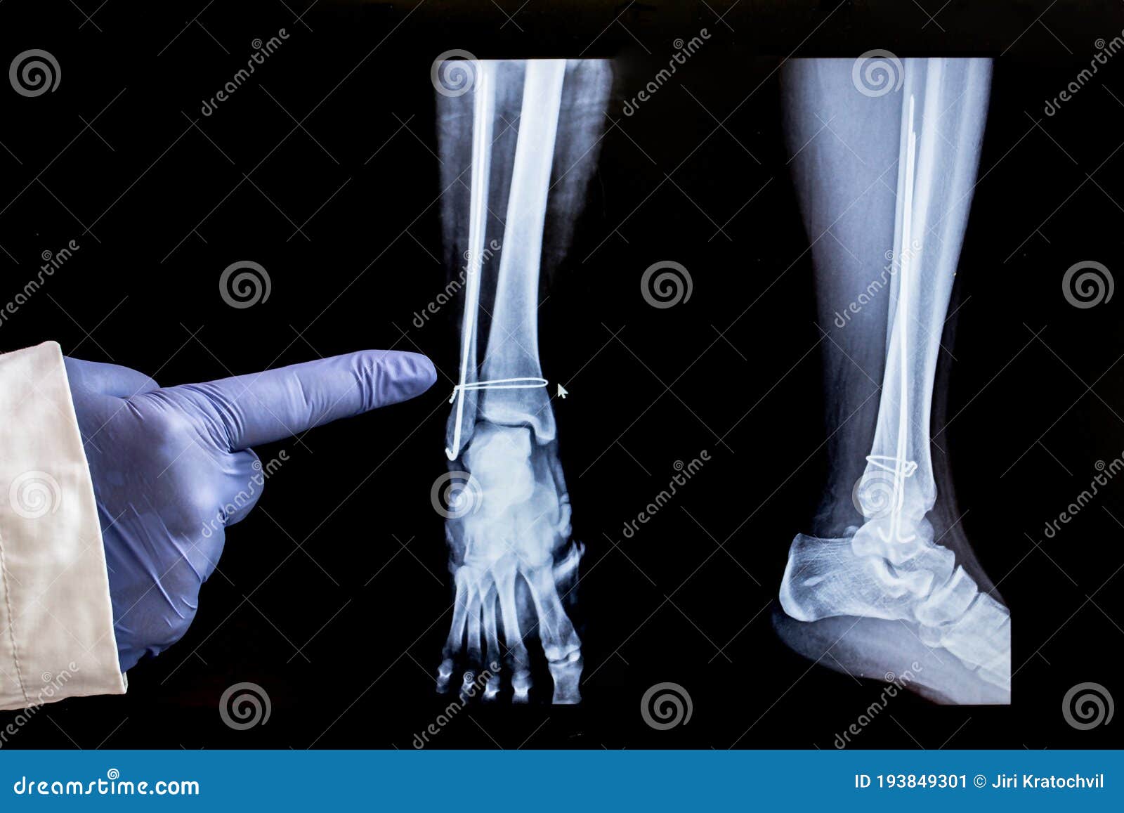 Ubrugelig Afledning hårdtarbejdende X-ray of the Leg after Surgery Stock Image - Image of isolated, bone:  193849301