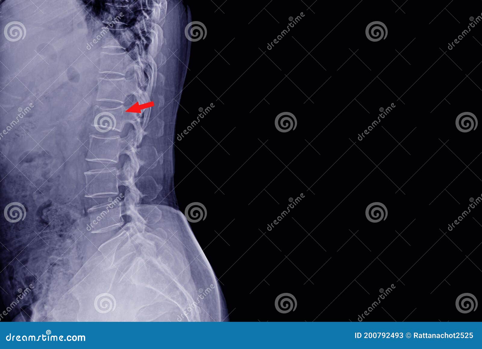 closed fracture of lumbar vertebrae closed fracture of lumbar vertebrae