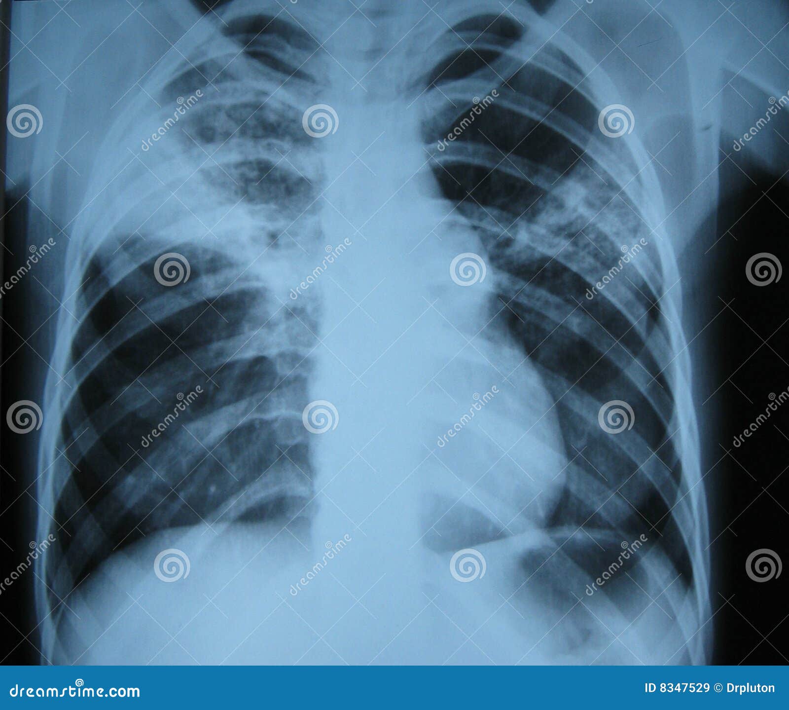 x-ray/lung